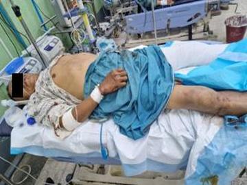 An innocent civilian injured in an improvised explosive device explosion planted  by a so-called PDF terrorists in Mogok Township of Mandalay Region.