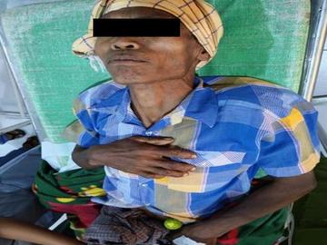 Man injured in a heavy weapon attack by so-called PDF terrorists in Nyaung-U Township of Mandalay Region.