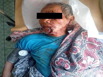 An innocent civilian killed in a landmine explosion planted by so-called  PDF terrorists in Salin Township of Magway Region.