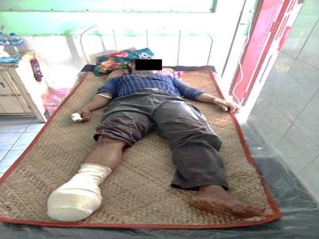 An innocent civilian injured in an improvised explosive device explosion in Thayetchaung Township of Tanintharyi Region.