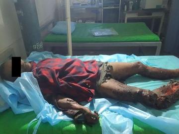 An innocent civilian injured in an improvised explosive device explosion in Naungcho Township of Shan State.