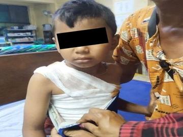 Child Injured After Stepping on Improvised Explosive Device Planted by TNLA Terrorist Group in Lashio Township of Shan State.