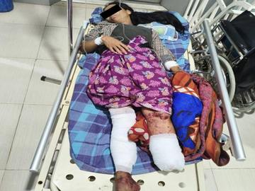 An innocent civilian injured in an improvised explosive device explosion in Kambalu Township of Sagaing Region.
