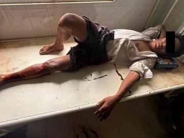An innocent civilian injured in an improvised explosive device explosion in Shwegyin Township of Bago Region.